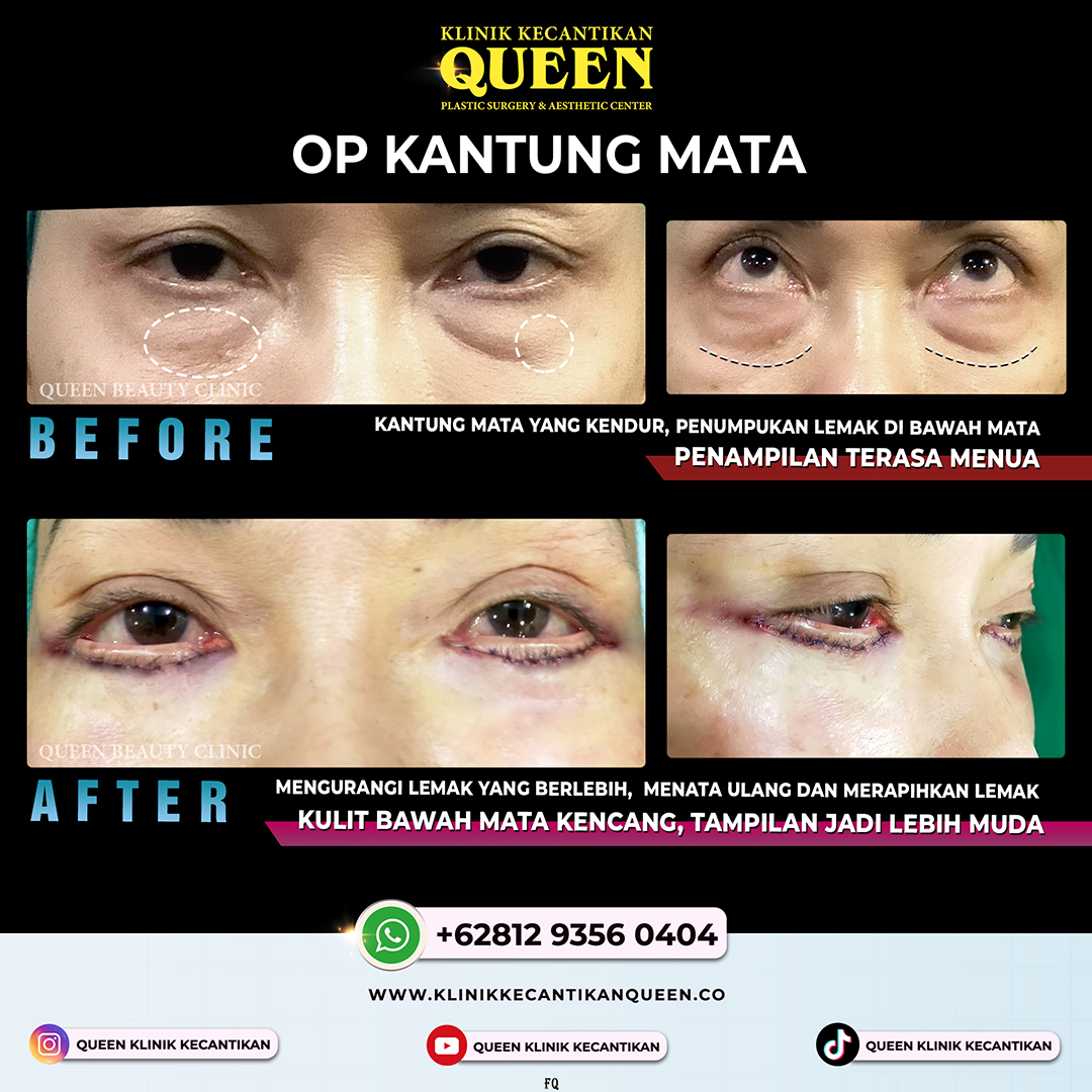 OP-KANTUNG-MATA
