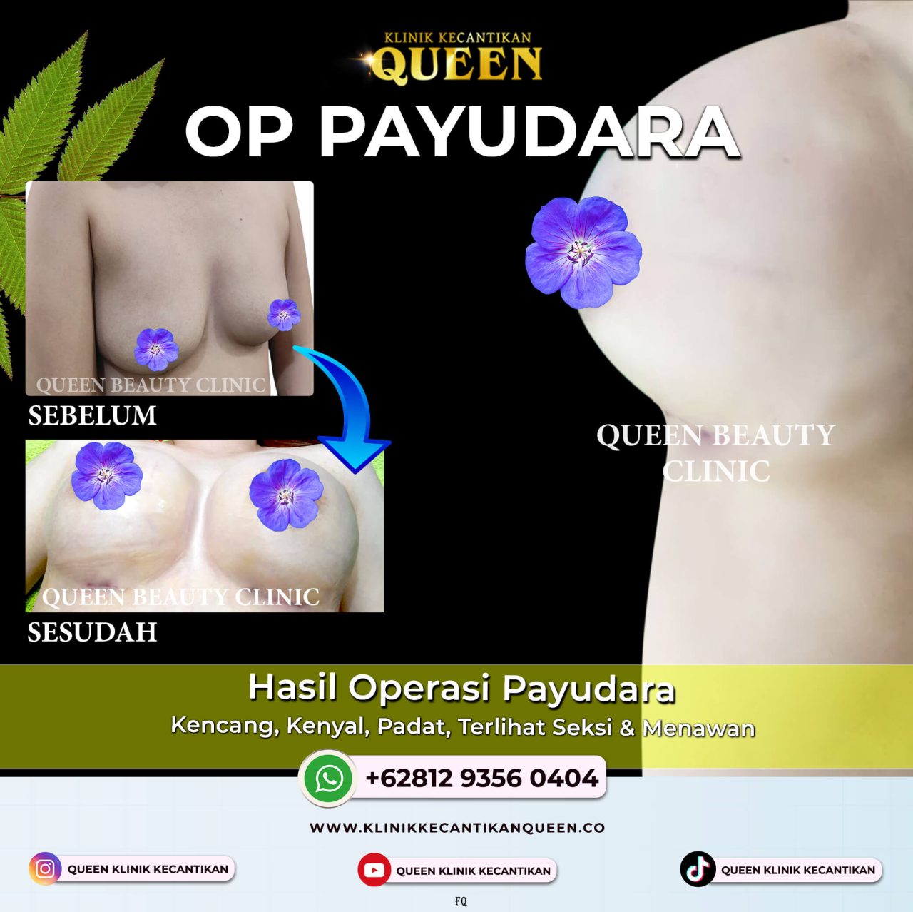 Hematoma Setelah Augmentasi Payudara: Apa yang Harus Anda Ketahui?