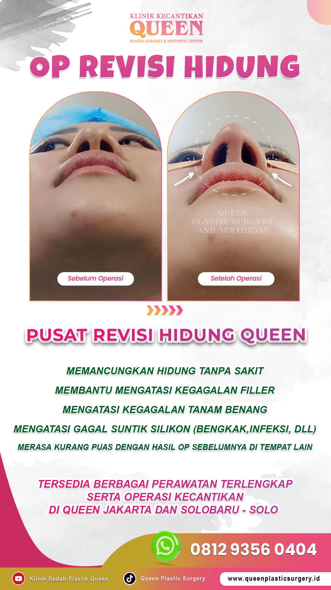 OP-REVISI-HIDUNG-STORY-001