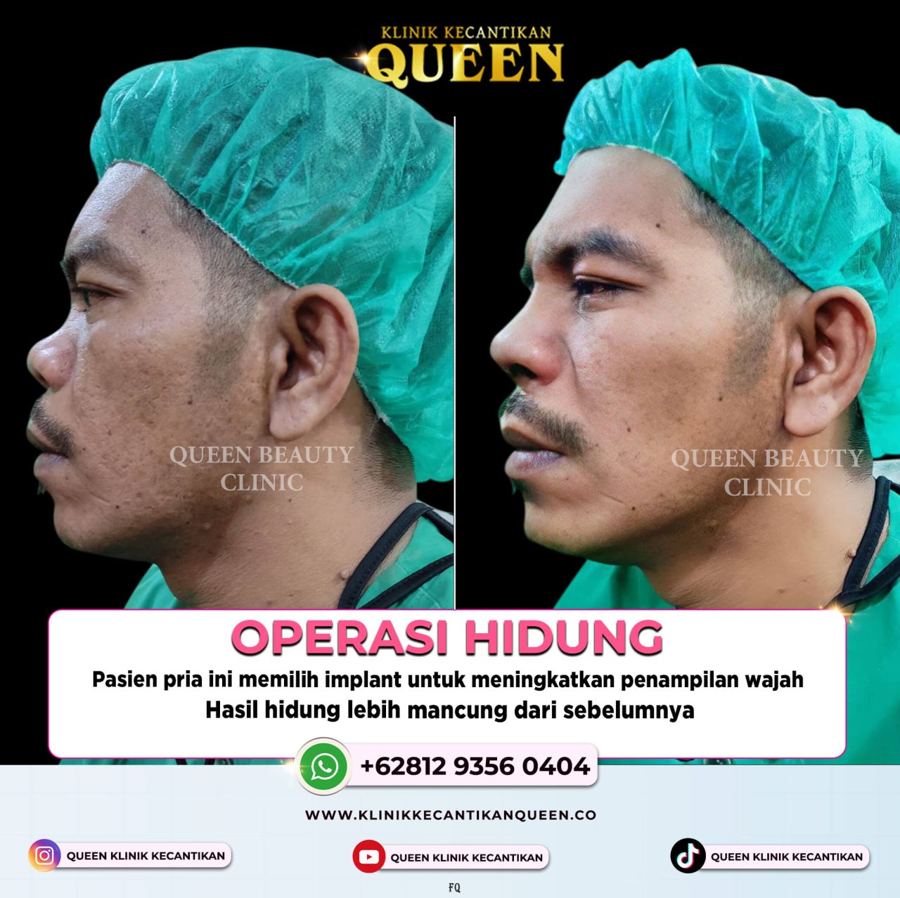 OPERASI HIDUNG PRIA