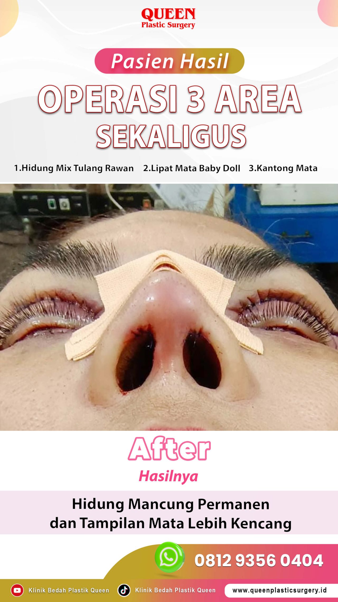 Operasi-3-Area-Sekaligus-After