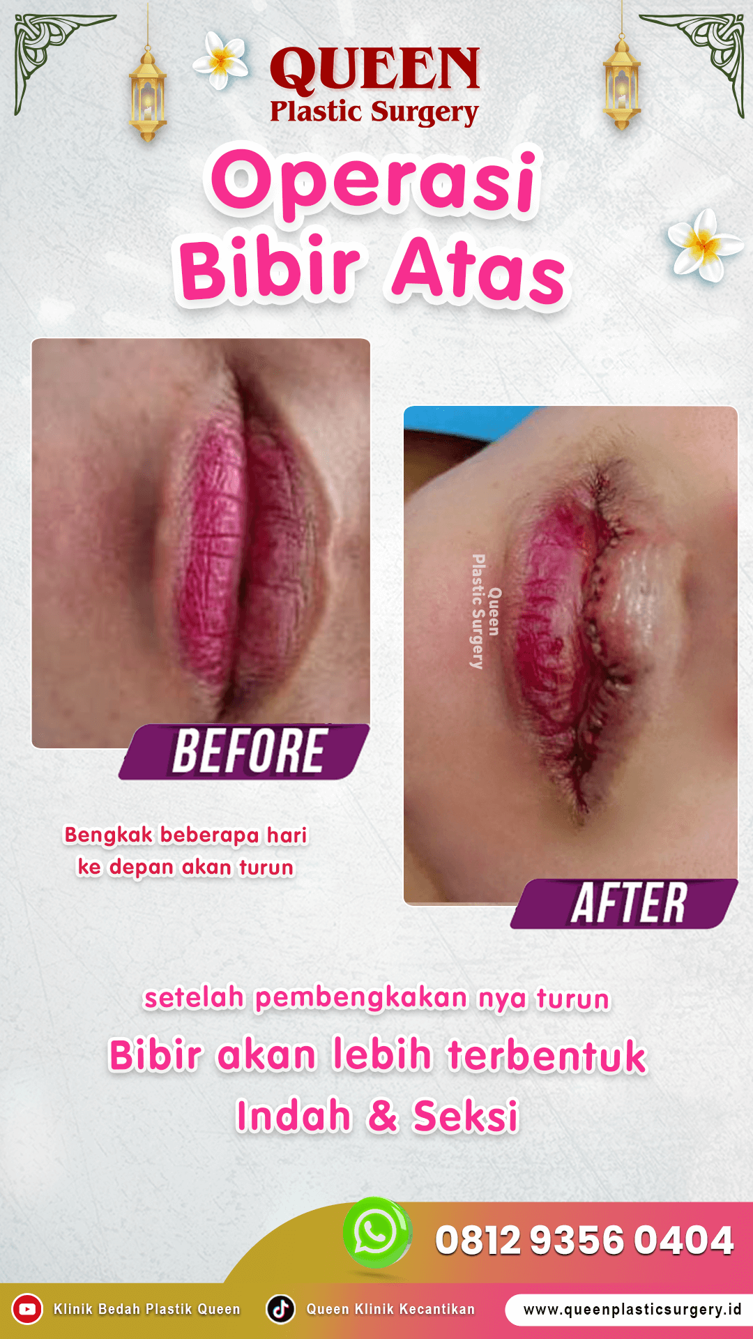 Operasi-Bibir-Atas-002 Operasi-Bibir-Atas-002
