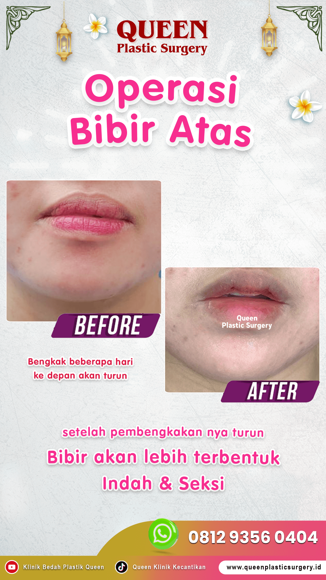 Operasi-Bibir-Atas Operasi-Bibir-Atas