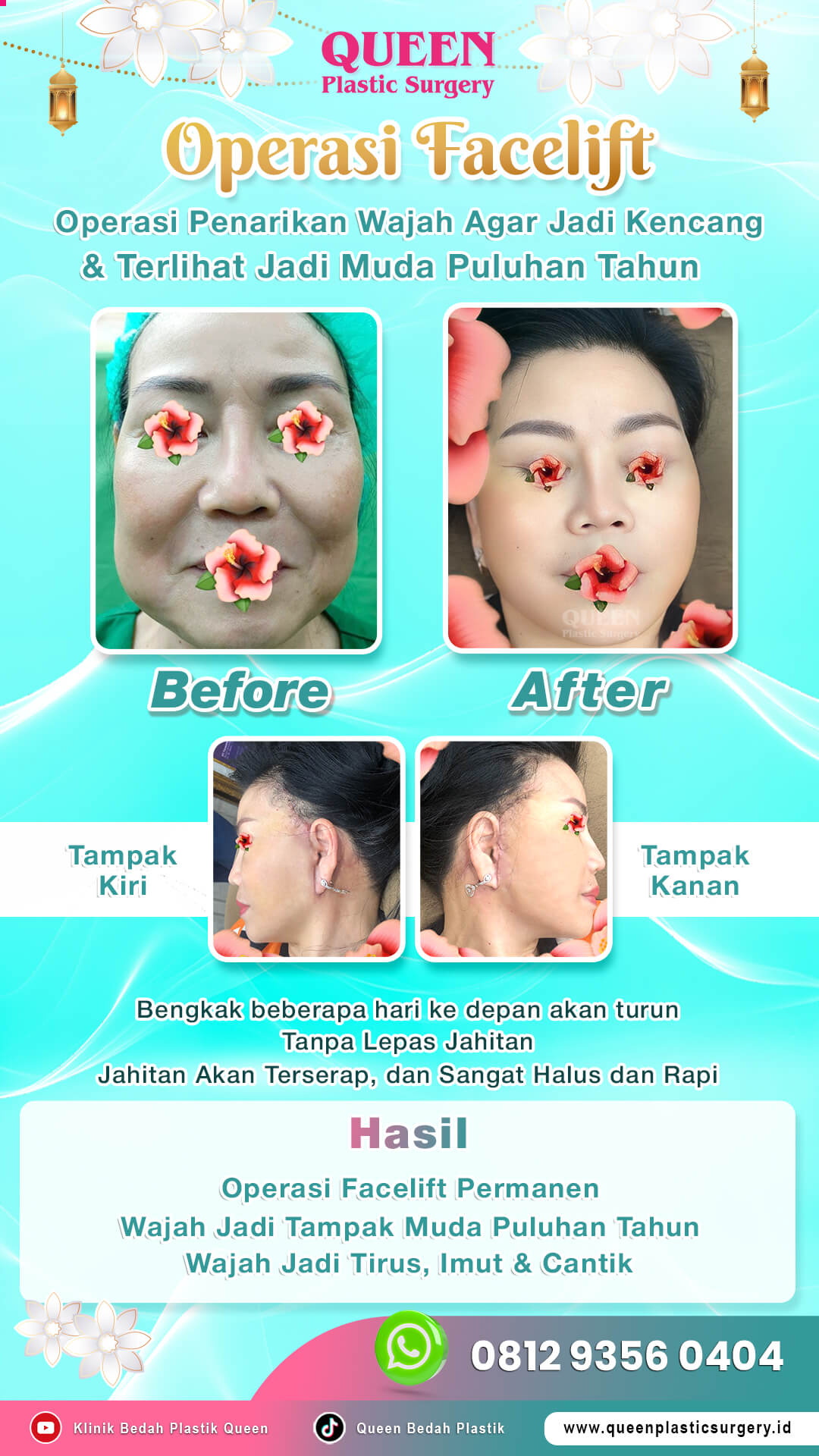 Hasil Face Surgery Queen Plastic Surgery, foto 8