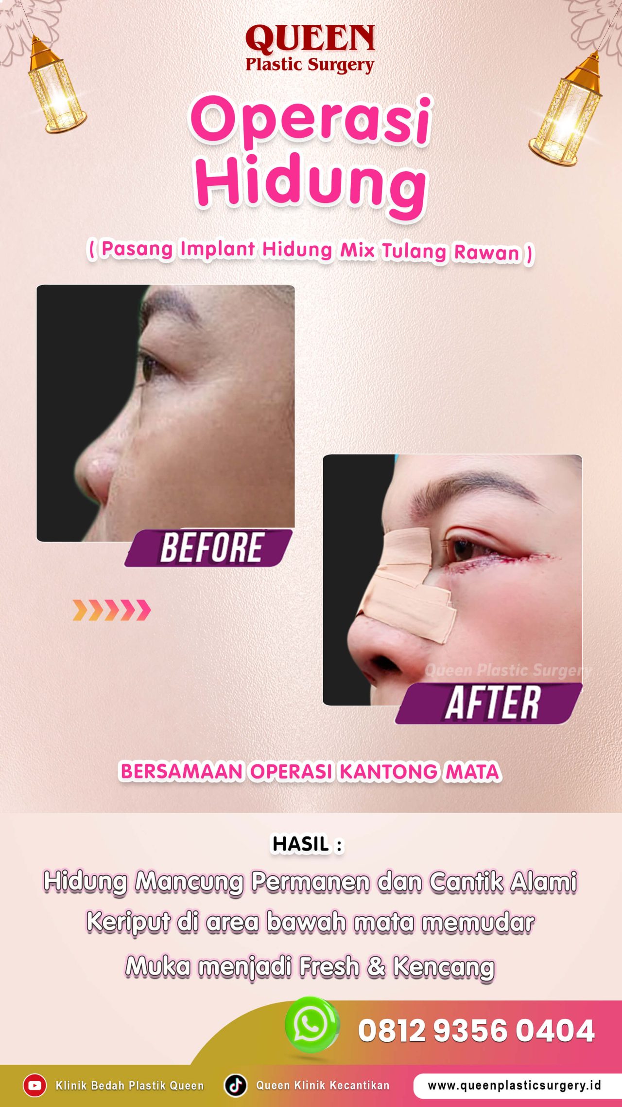 Operasi-Hidung-002 (2)