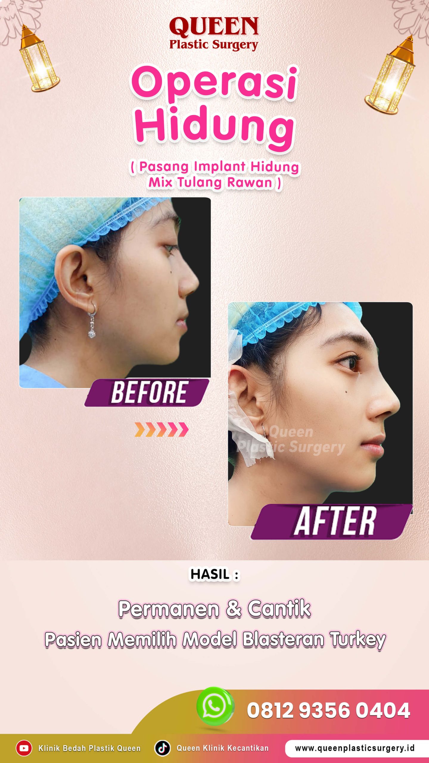 Operasi-Hidung-002