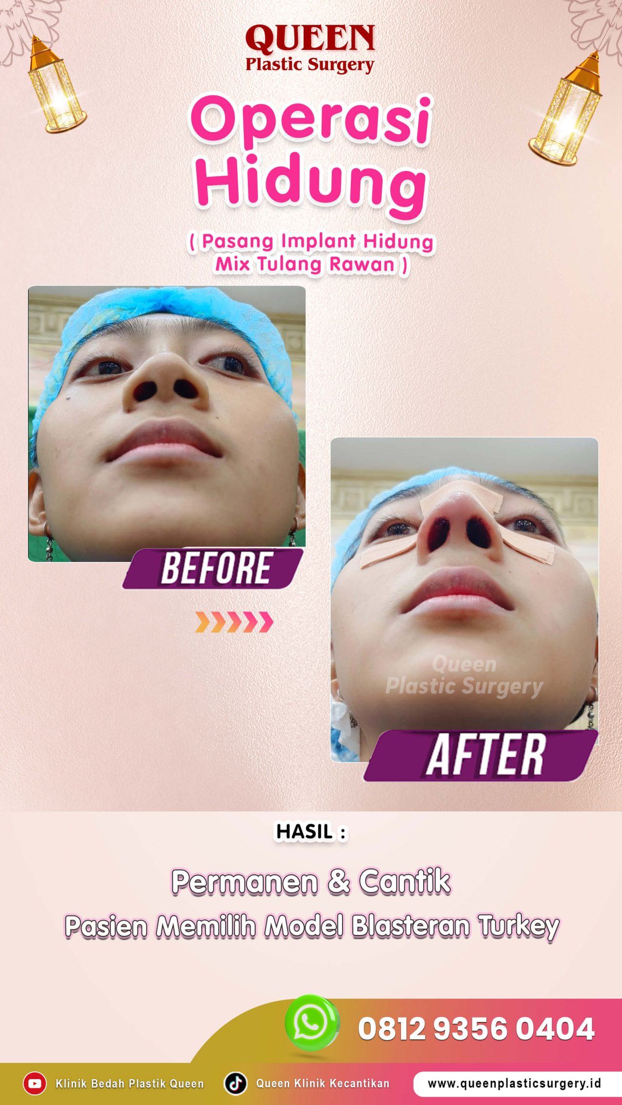Operasi-Hidung-003