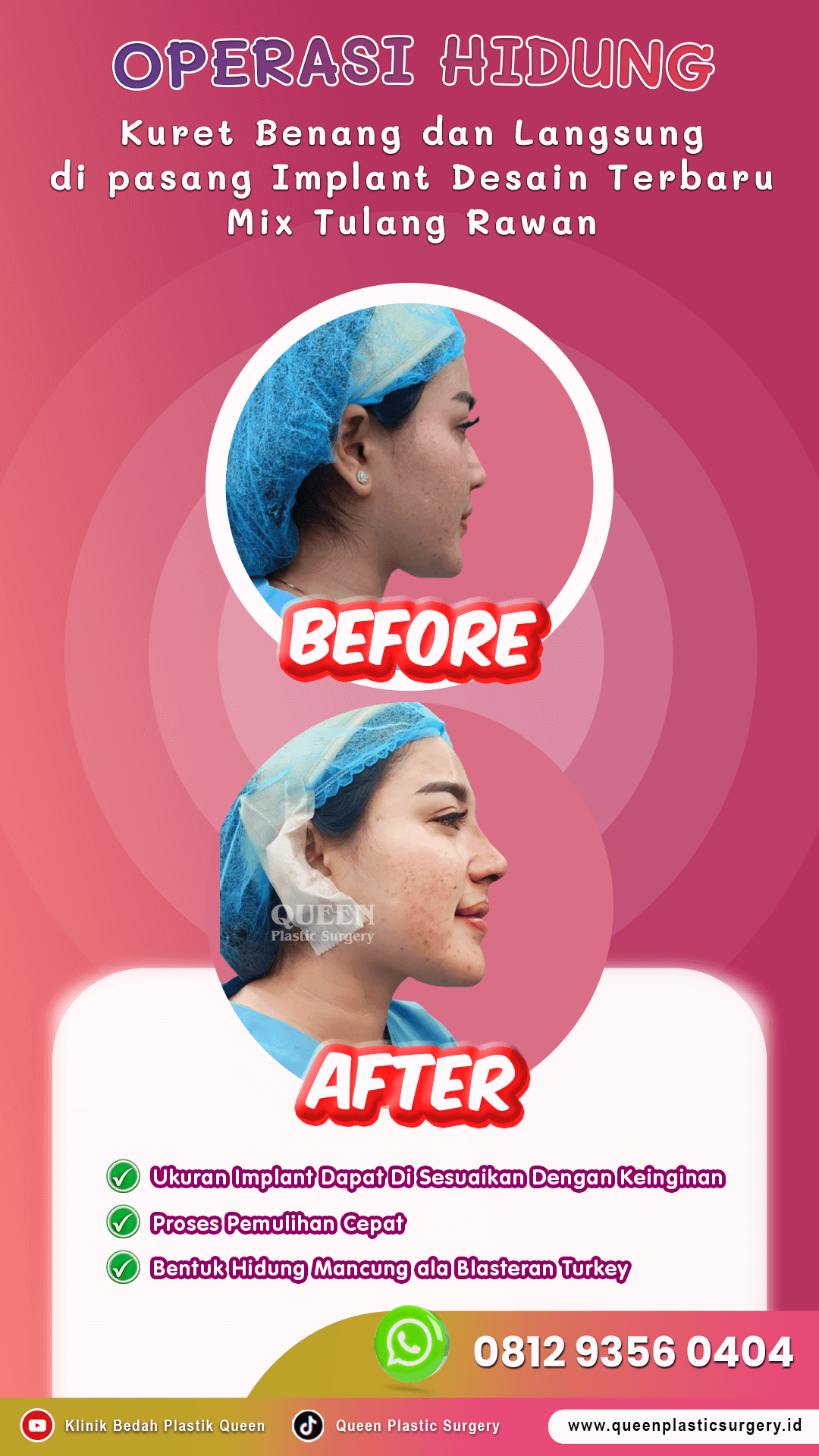 Operasi-Hidung-02