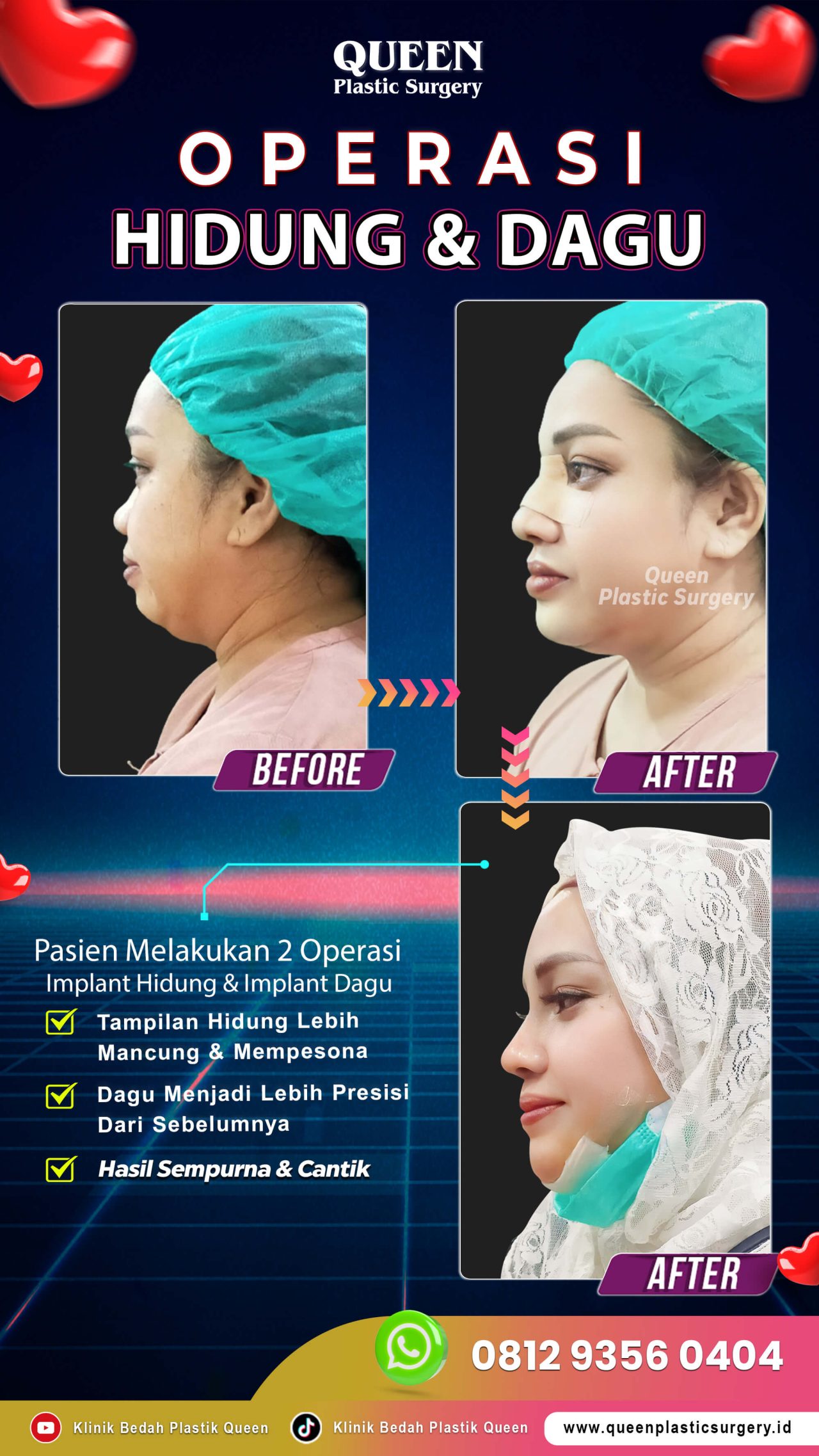 Operasi-Hidung-&-Dagu-IGS-002-Queen (1)