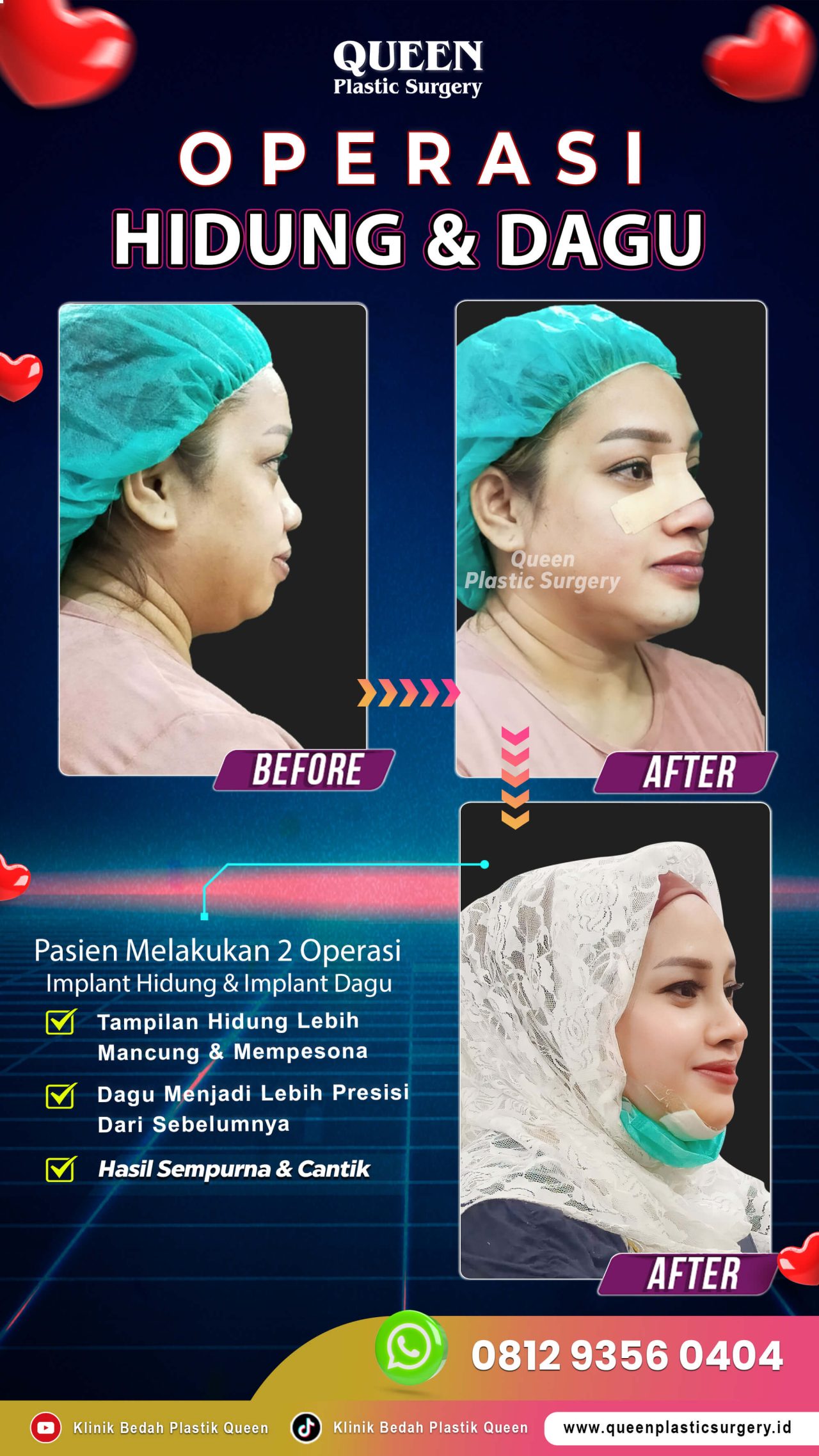 Operasi-Hidung-&-Dagu-IGS-Queen (1)