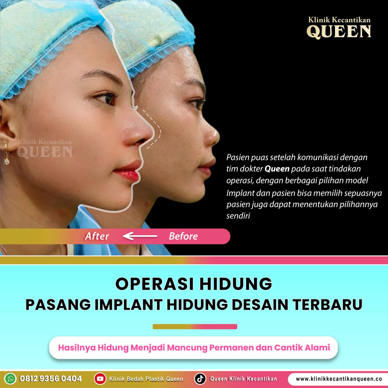 Operasi-Hidung-IG-Feed-003
