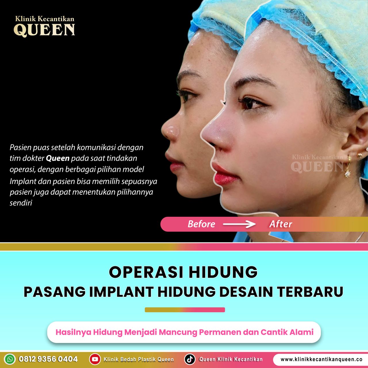 Operasi-Hidung-IG-Feed-004