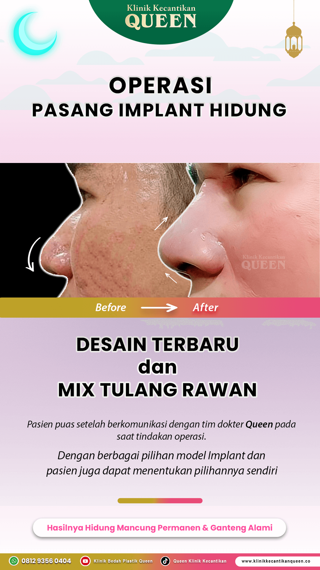 Operasi-Hidung-Laki2-02-IG-Story