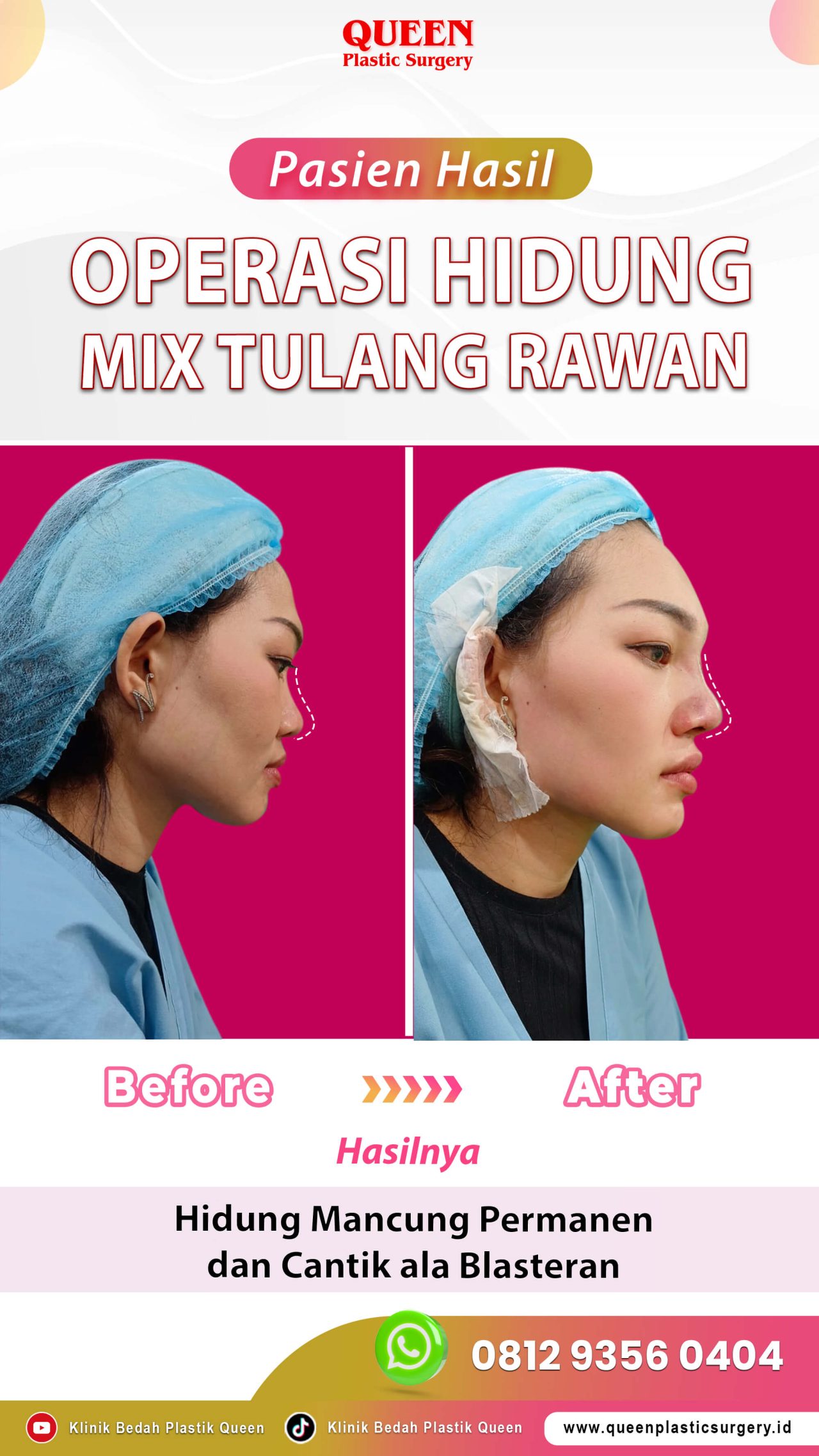 Operasi-Hidung-Mix-Tulang-Rawan-IGS-002