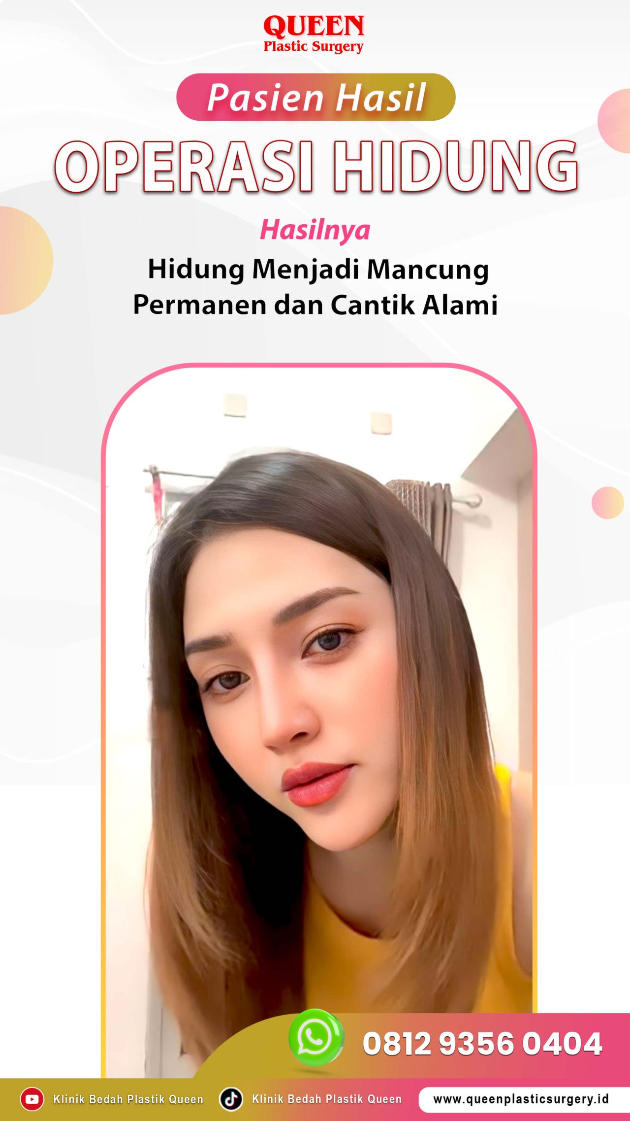 Operasi-Hidung-Pasien-IG-Story