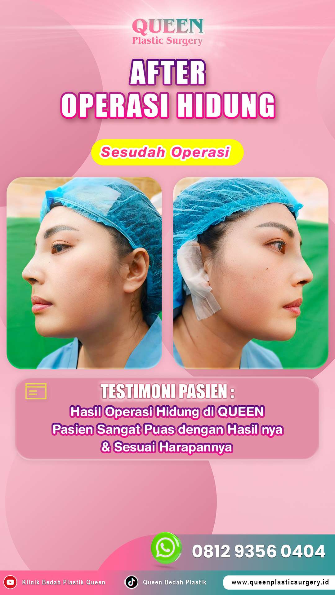 Operasi-Hidung-Testimoni-Pasien-Queen-010-