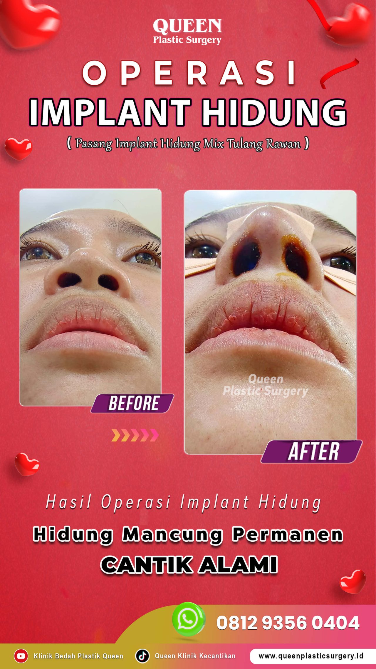 Operasi-Implant-Hidung-03