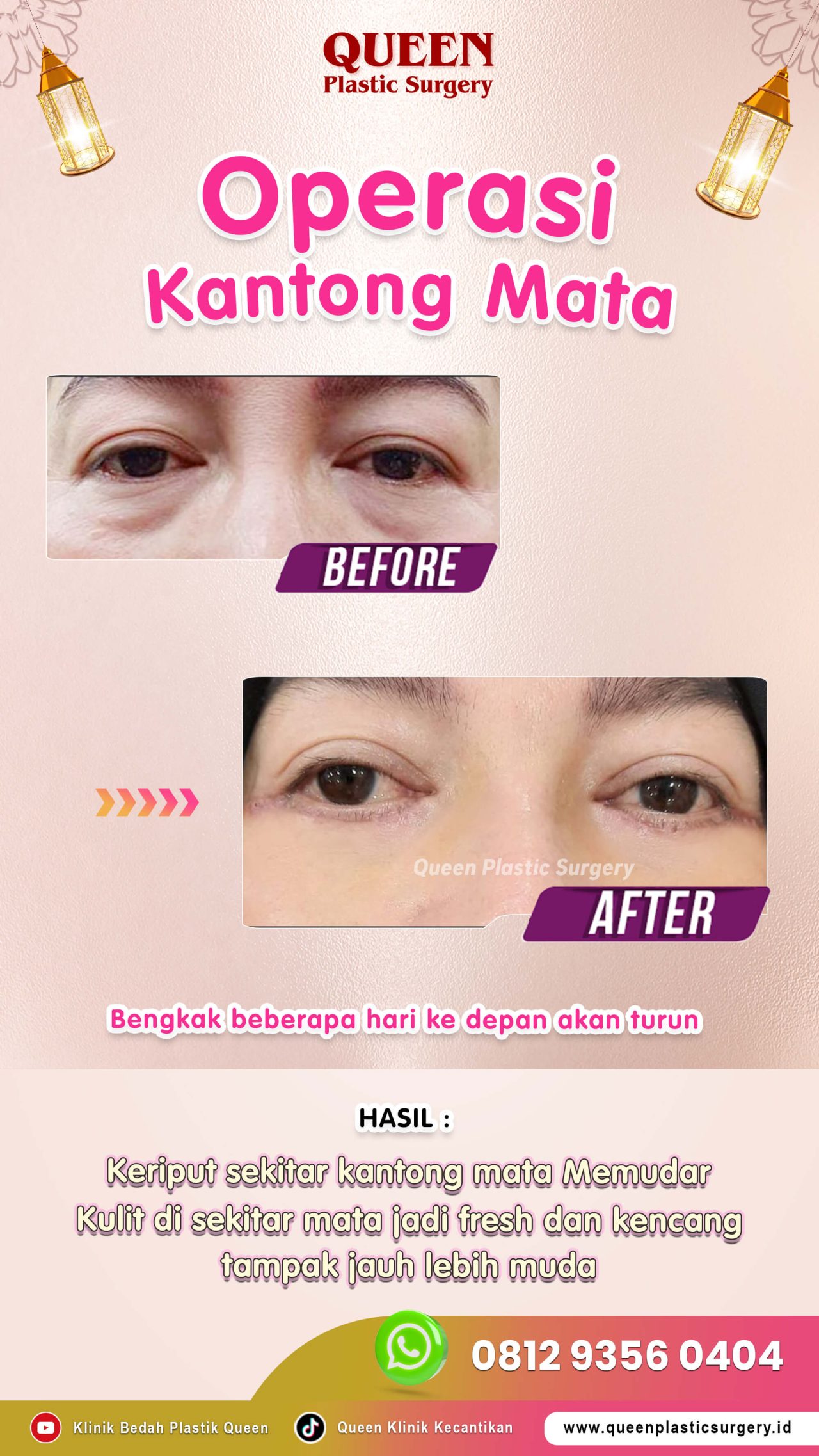 Operasi-Kantong-Mata