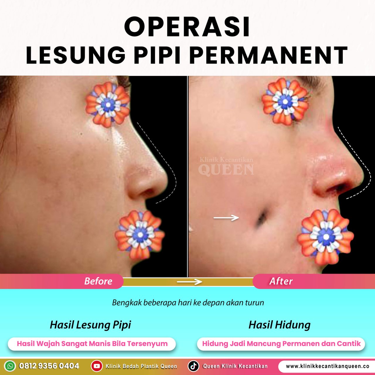 Operasi-Lesung-Pipi-Permanent-04 Operasi-Lesung-Pipi-Permanent-04