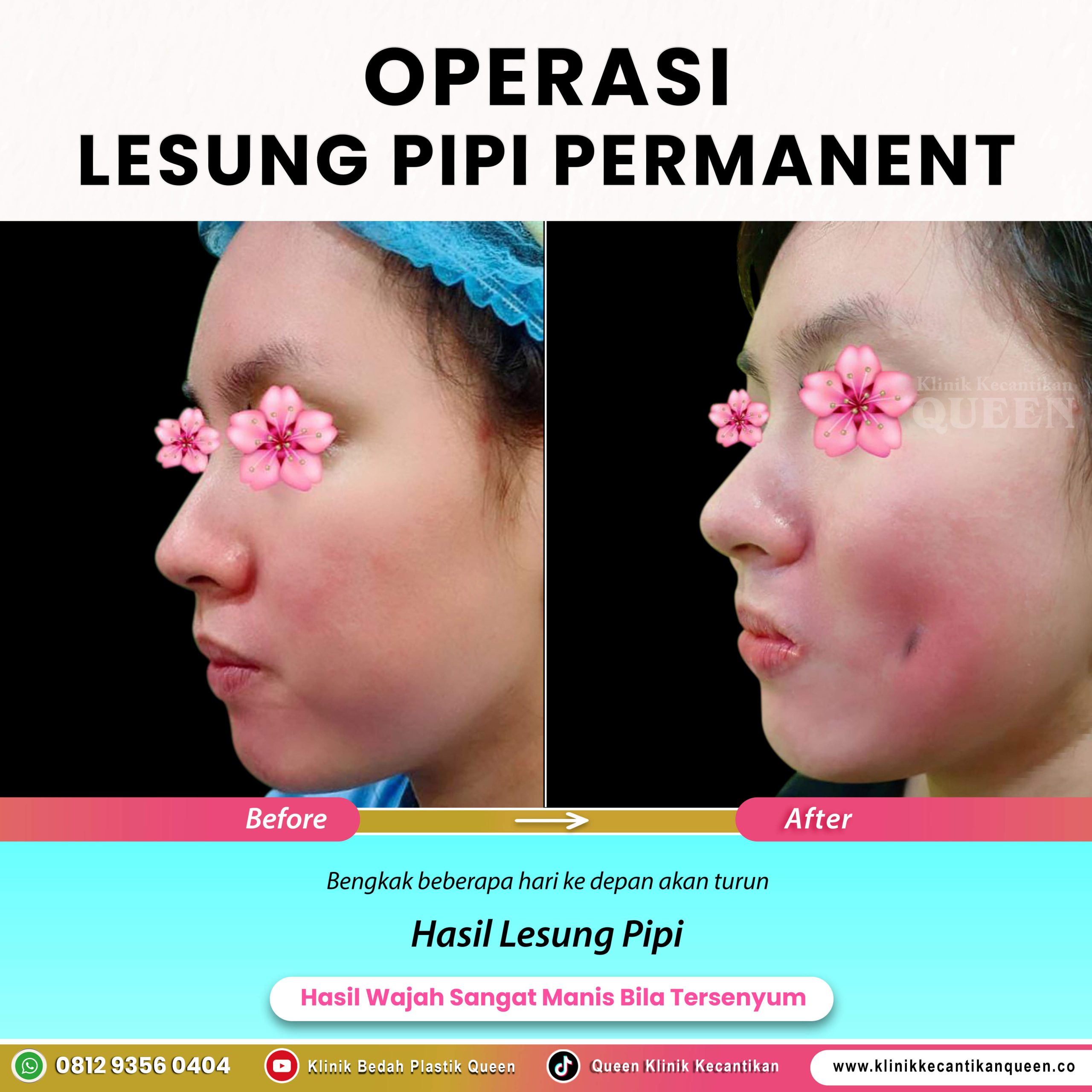 Operasi-Lesung-Pipi-Permanent