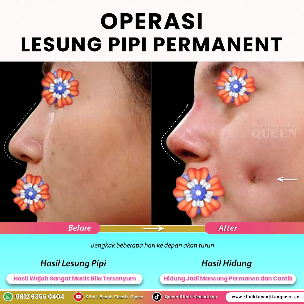 Operasi-Lesung-Pipi-Permanent03 Operasi-Lesung-Pipi-Permanent03