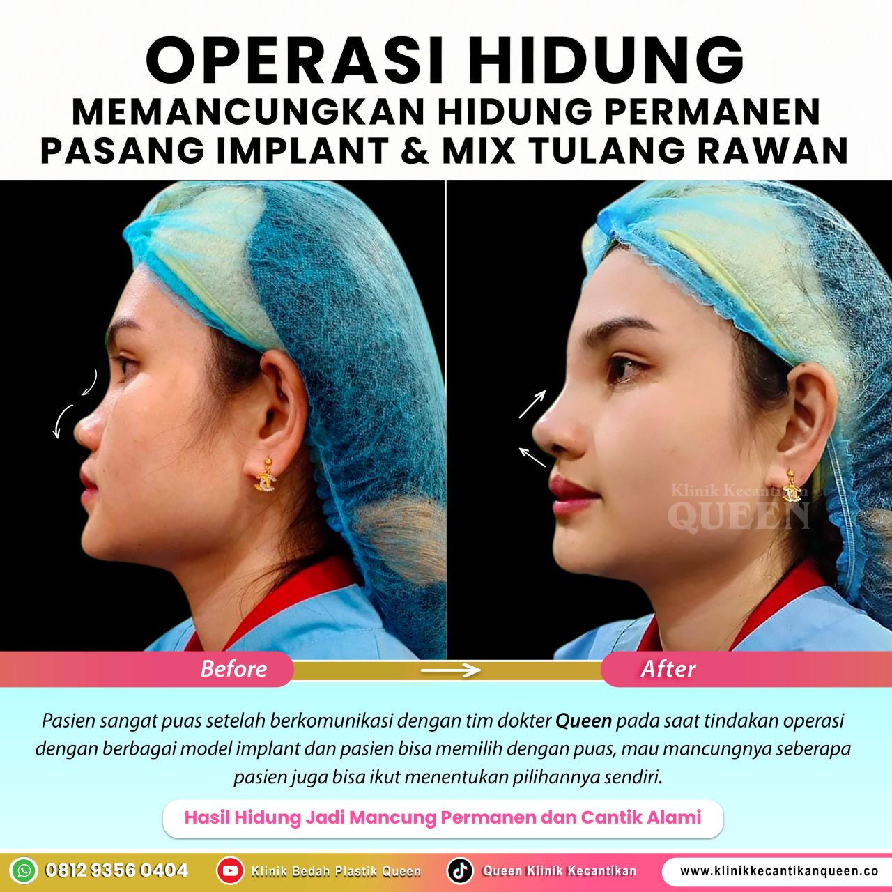 Operasi-Memancungkan-Hidung-Permanent-002