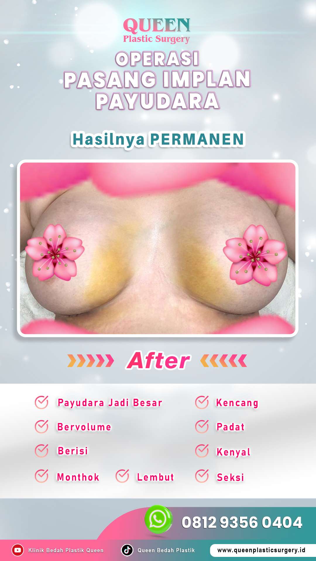 Operasi-Pasang-Implan-Payudara-02-(After)-fotor-202405241538