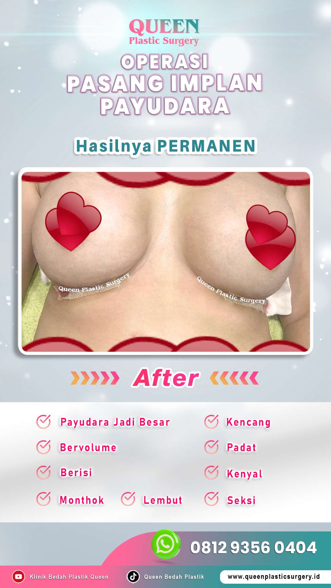 Operasi-Pasang-Implan-Payudara-06-(After)-fotor-20240525132611