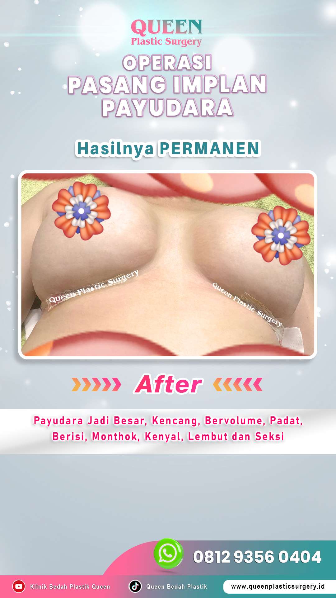 Operasi-Pasang-Implan-Payudara-07-(After)-fotor-20240525132548