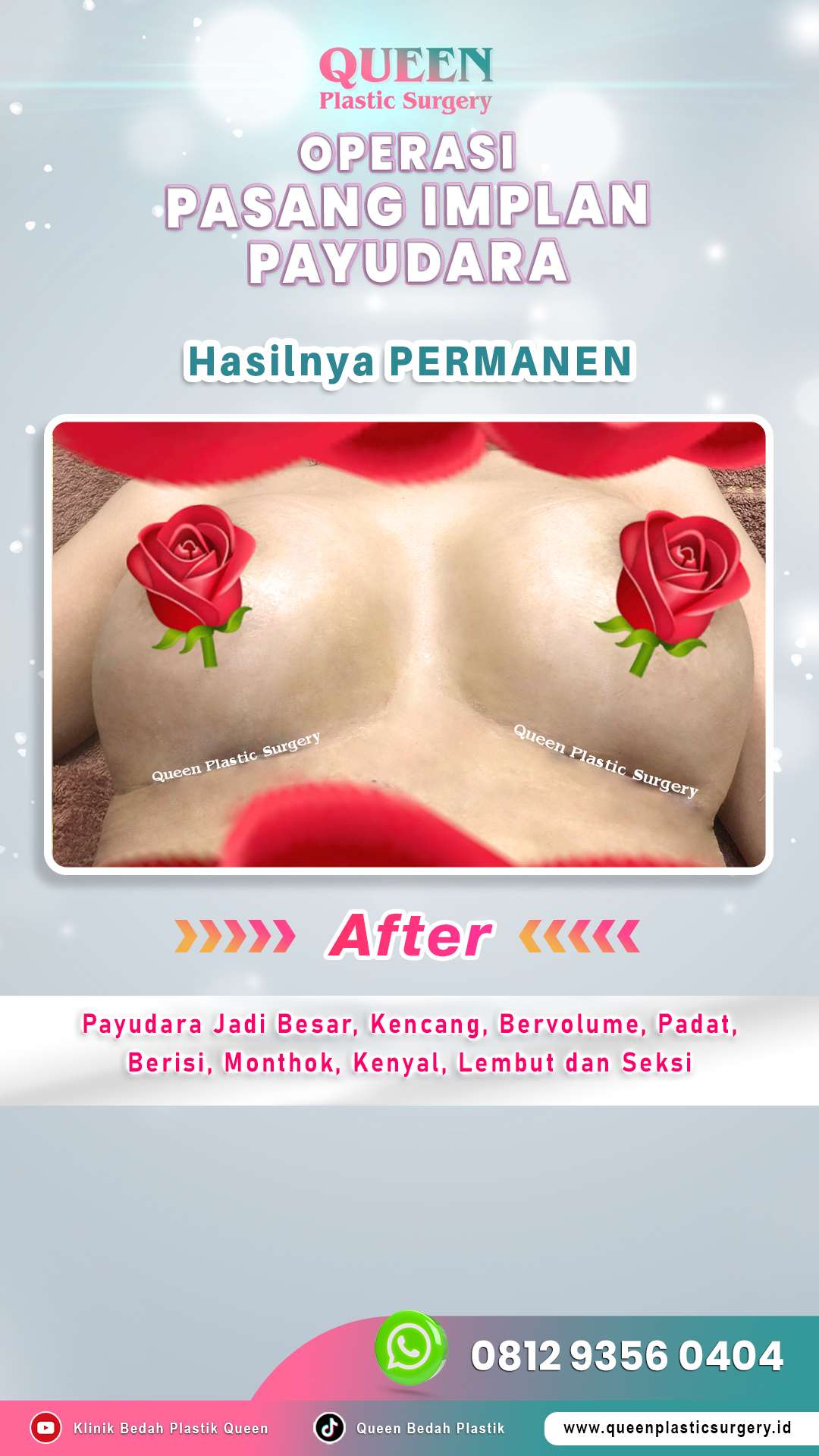 Operasi-Pasang-Implan-Payudara-08-(After)-fotor-20240525132555