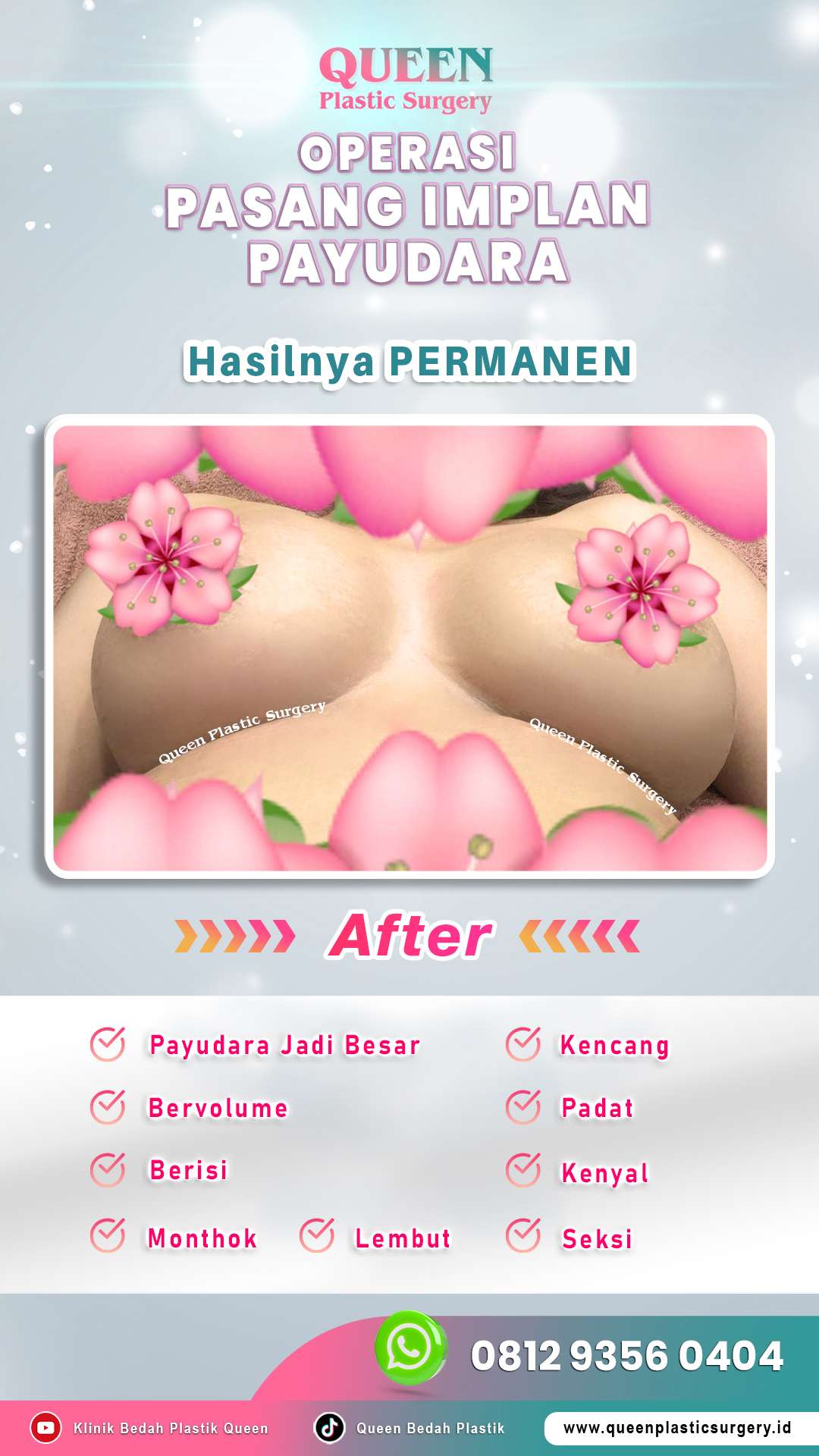 Operasi-Pasang-Implan-Payudara-09-(After)-fotor-20240525132529