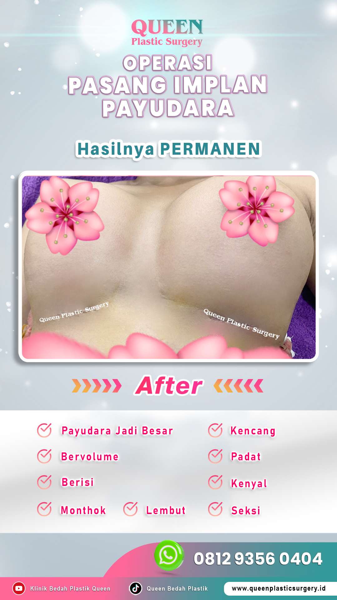 Operasi-Pasang-Implan-Payudara-10-(After)-fotor-20240525132519
