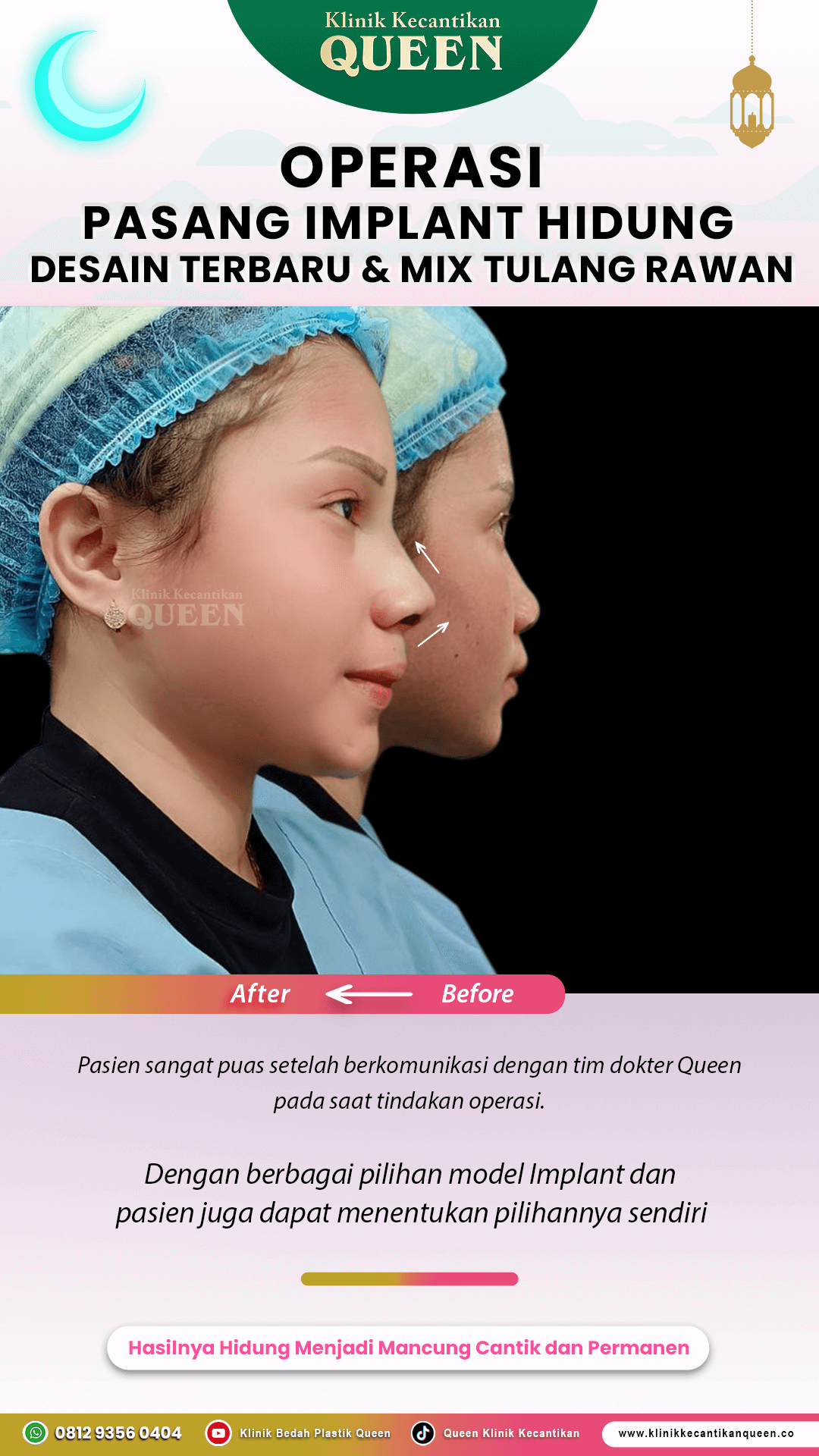 Operasi-Pasang-Implant-Hidung-IG-Story04