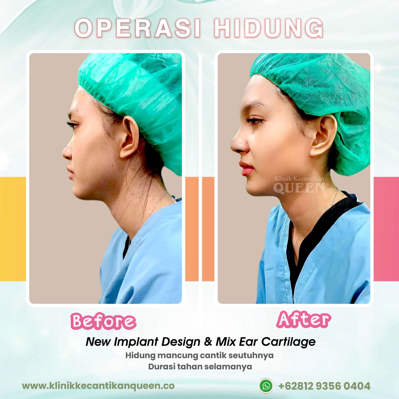 Operasi-Pasang-Implant-Hidung02