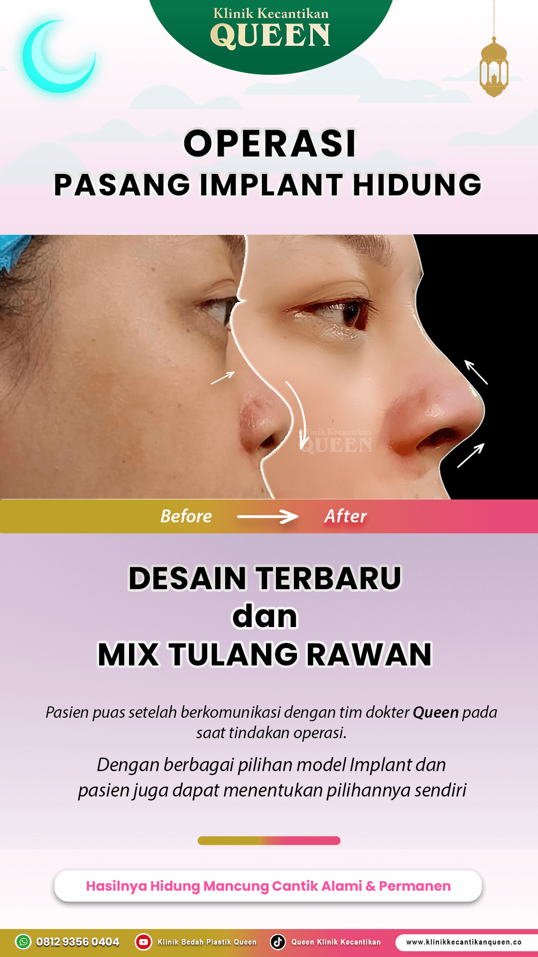 Operasi-Pasang-Implant-IG-Story-06