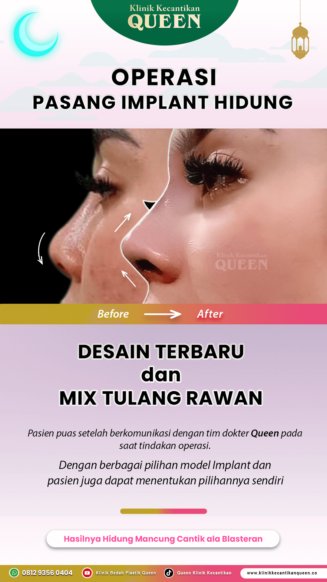 Operasi-Pasang-Implant-IG-Story-13
