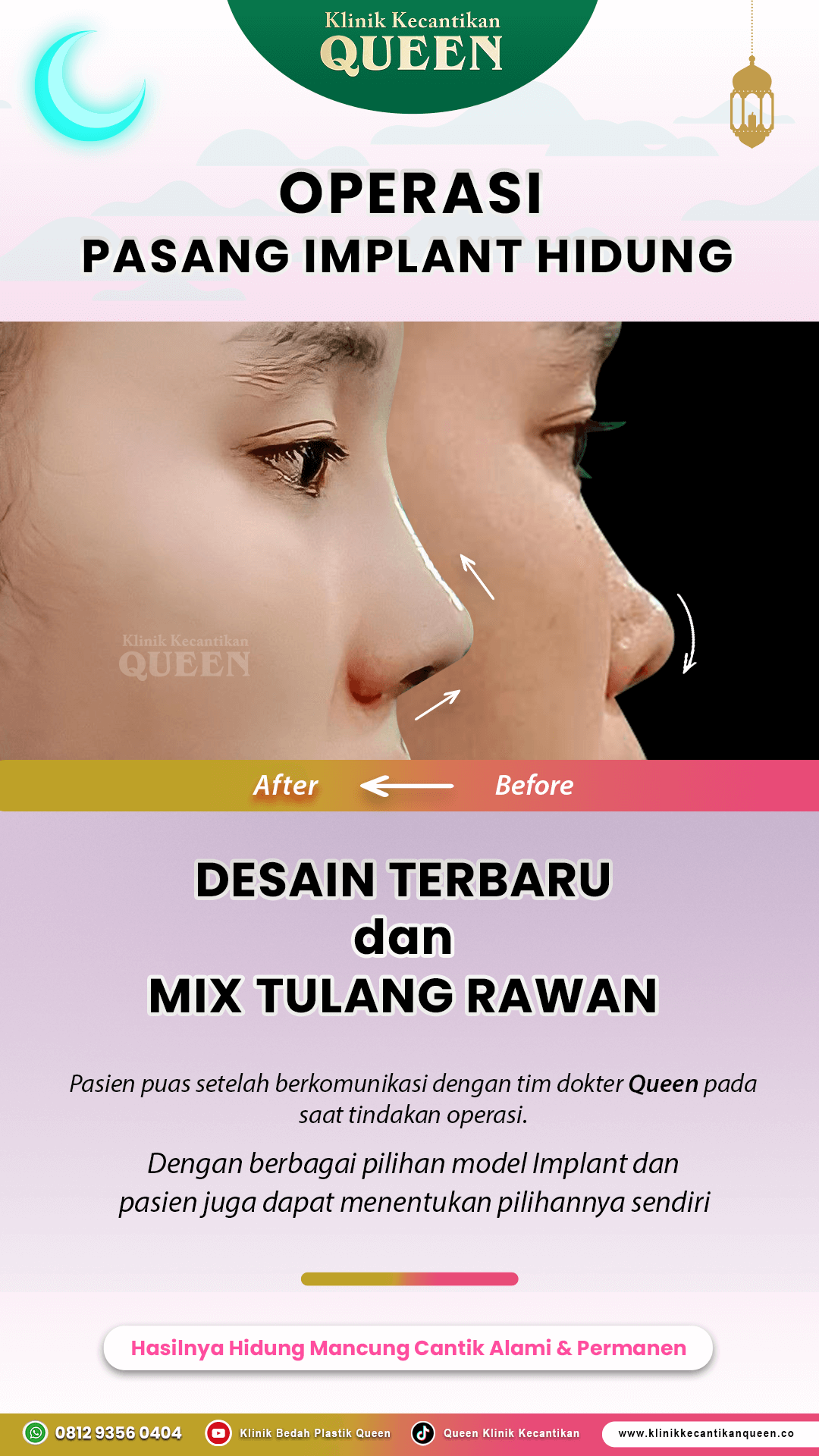 Operasi-Pasang-Implant-IG-Story-15