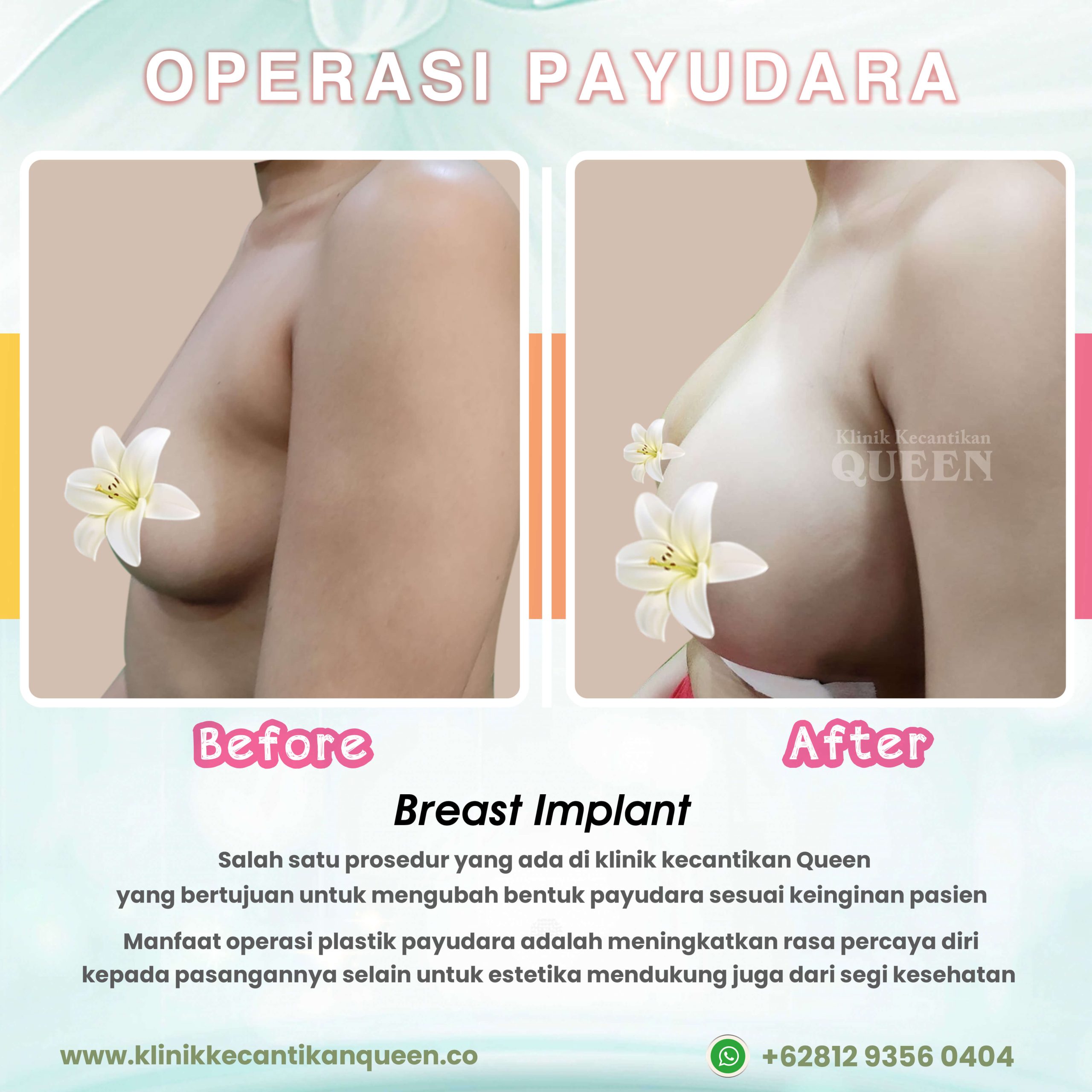 Operasi-Payudara