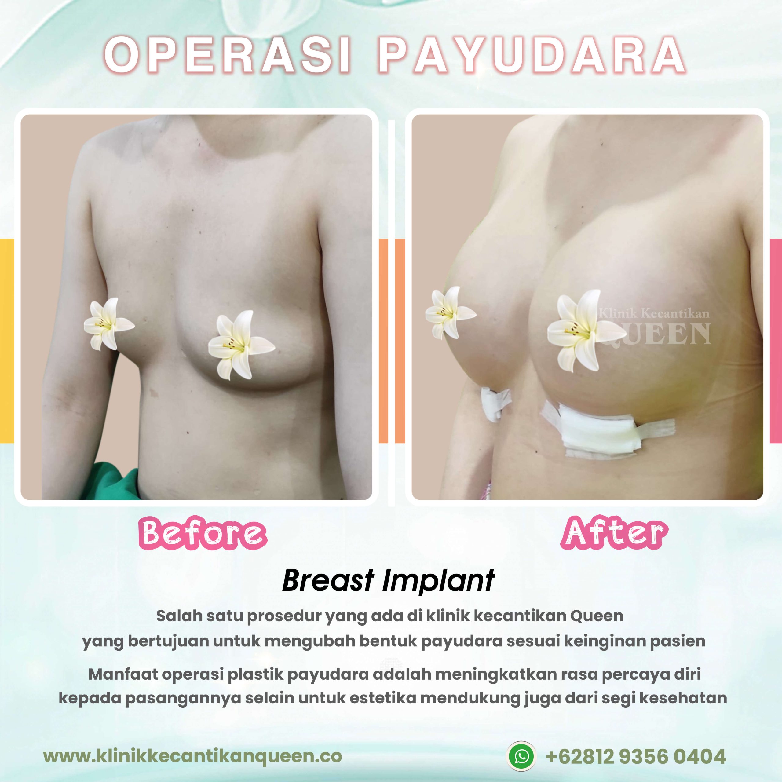 Operasi-Payudara02
