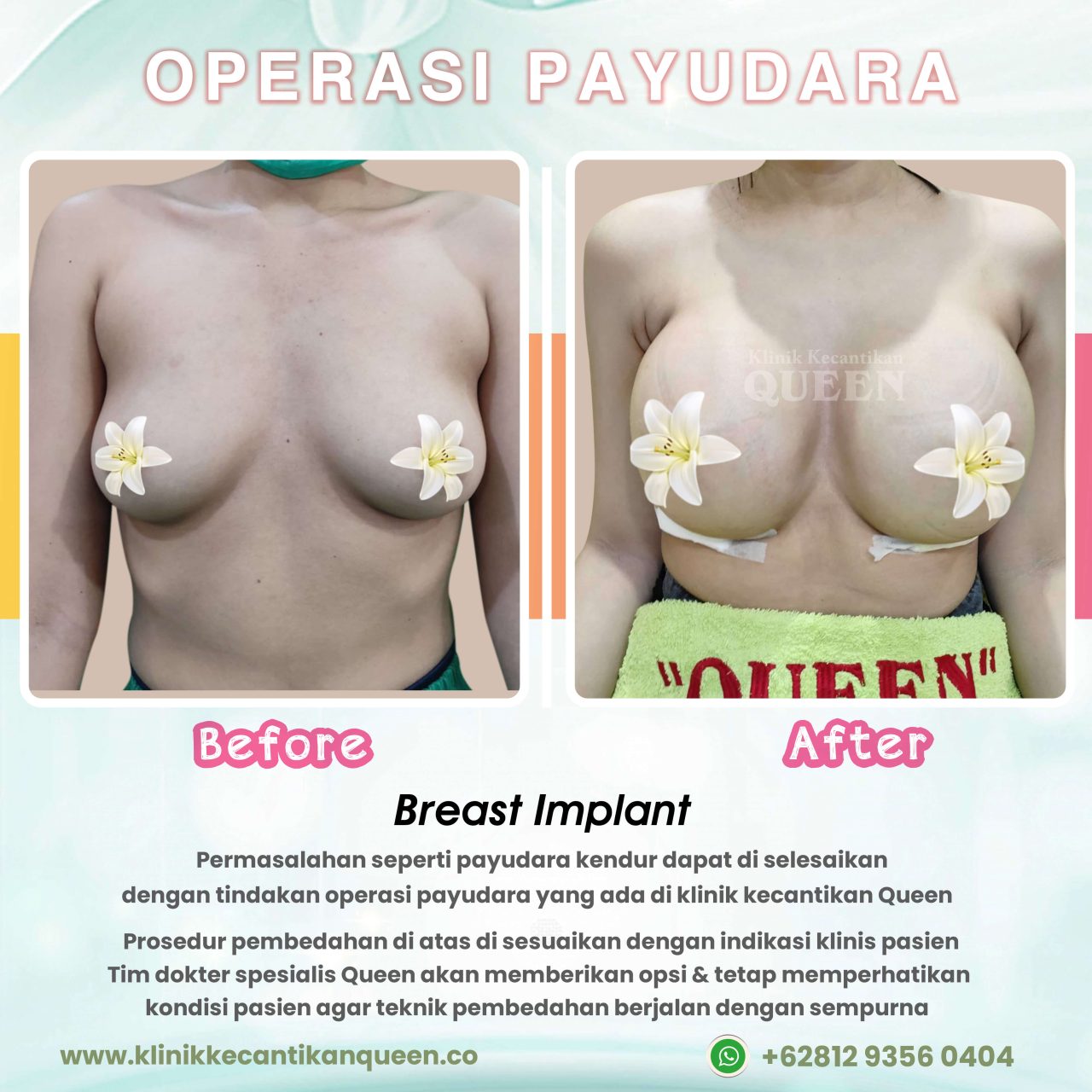 Operasi-Payudara03