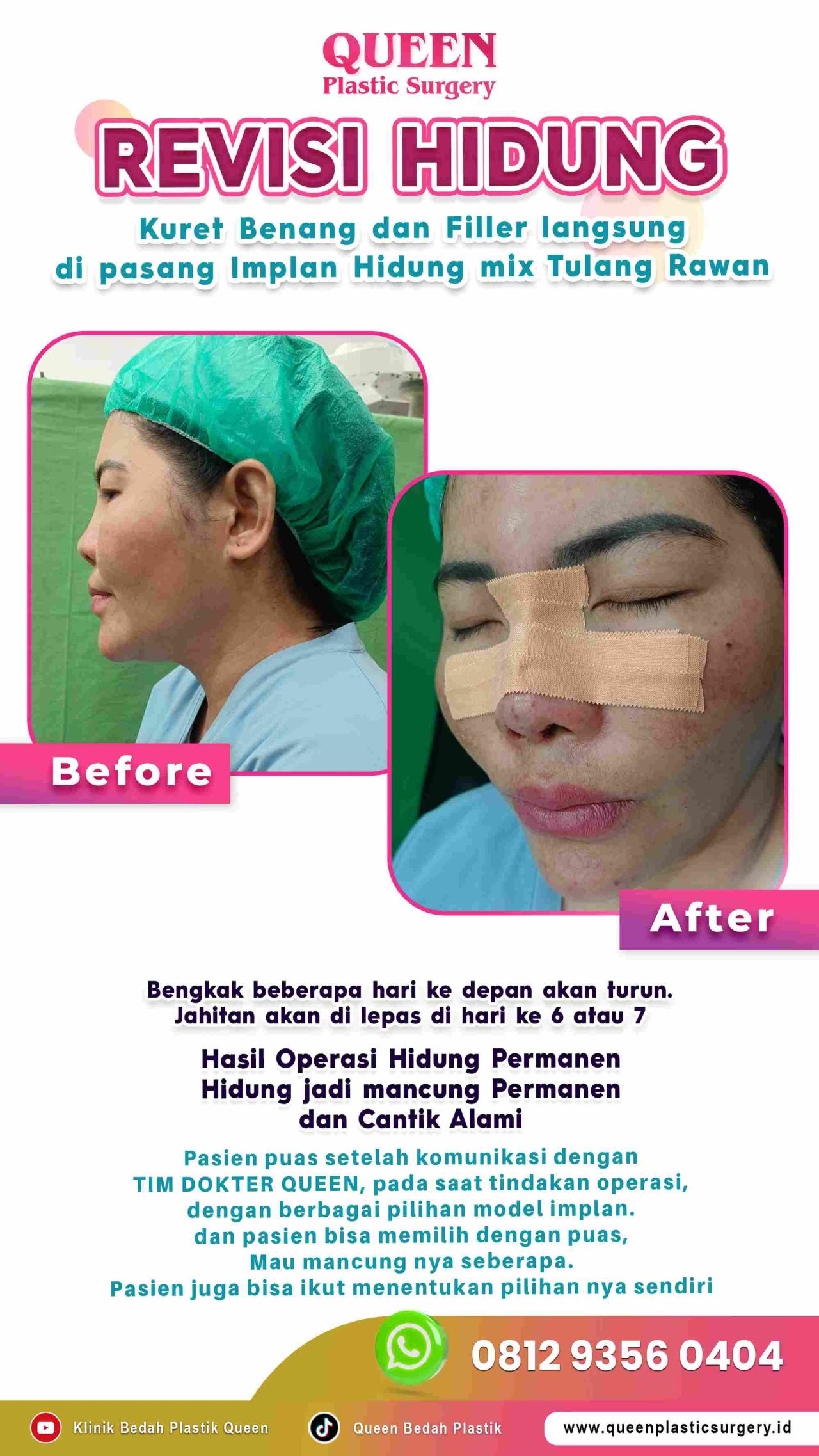 Operasi-Revisi-Hidung-003-