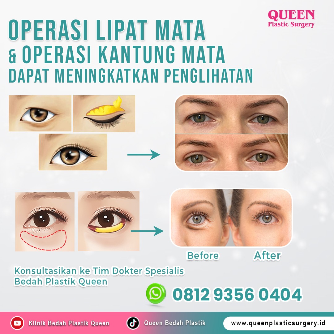 Operasi_Lipat_Mata_&_Operasi_Kantung_Mata_Web_Banner_Article