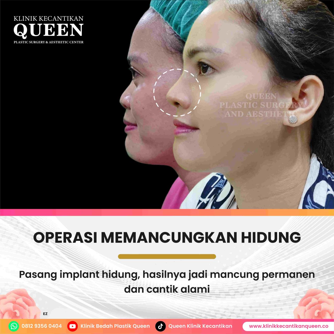 Dampak Alkohol Sebelum dan Sesudah Operasi Plastik: Pentingnya Memahami!