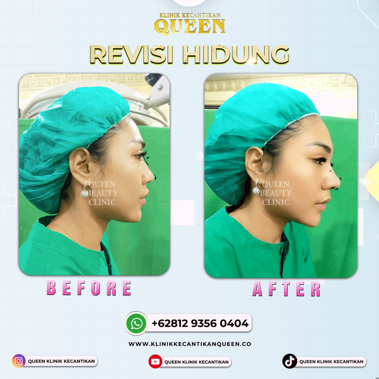 REVISI HIDUNG 00