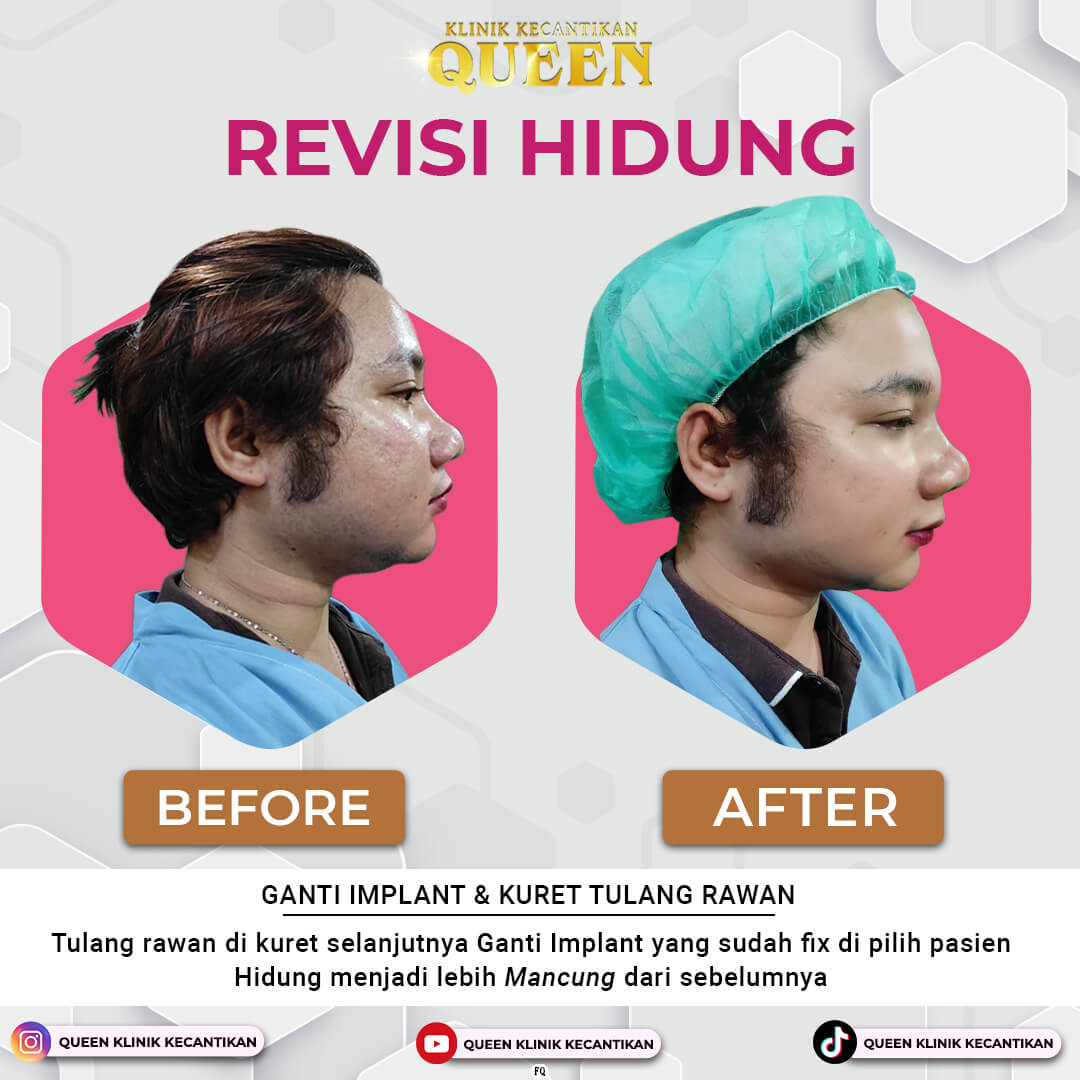 REVISI HIDUNG 001