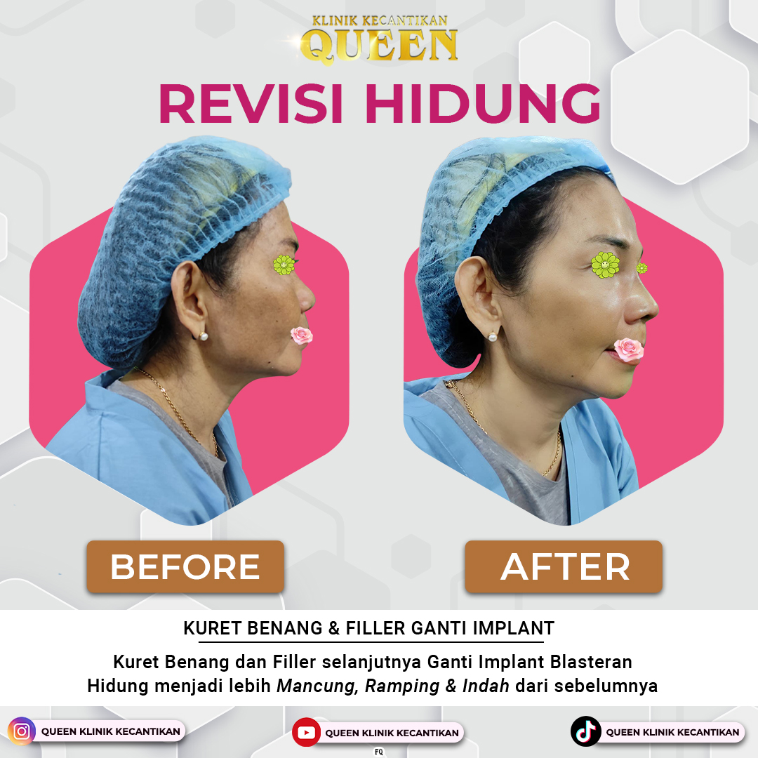 REVISI-HIDUNG-002