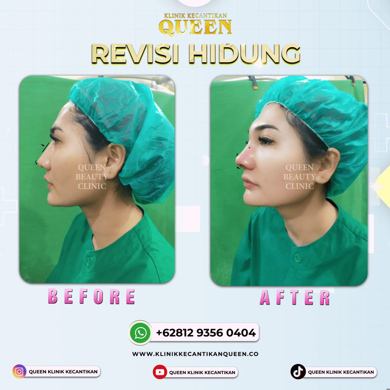 REVISI HIDUNG 03 (2)