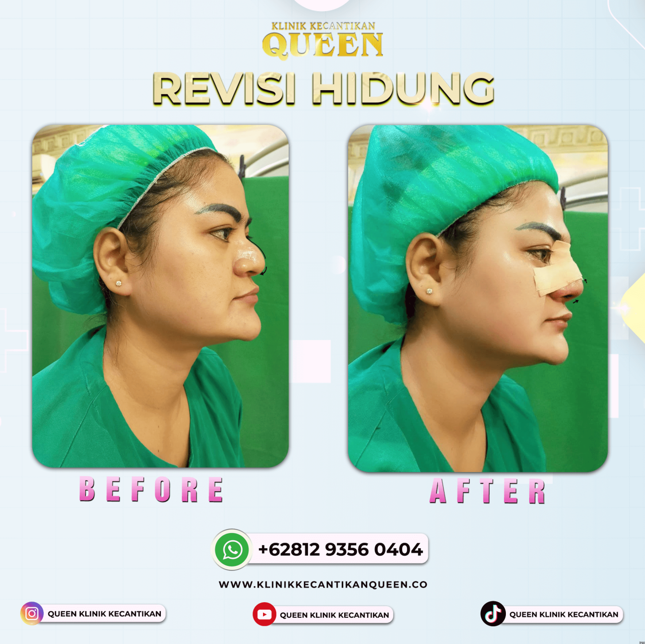 REVISI HIDUNG 04