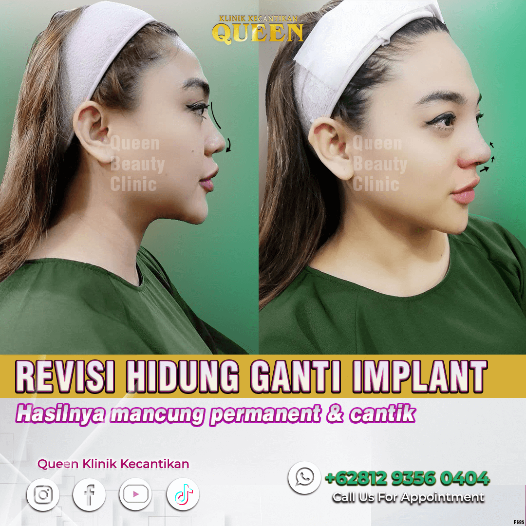 REVISI HIDUNG (2)