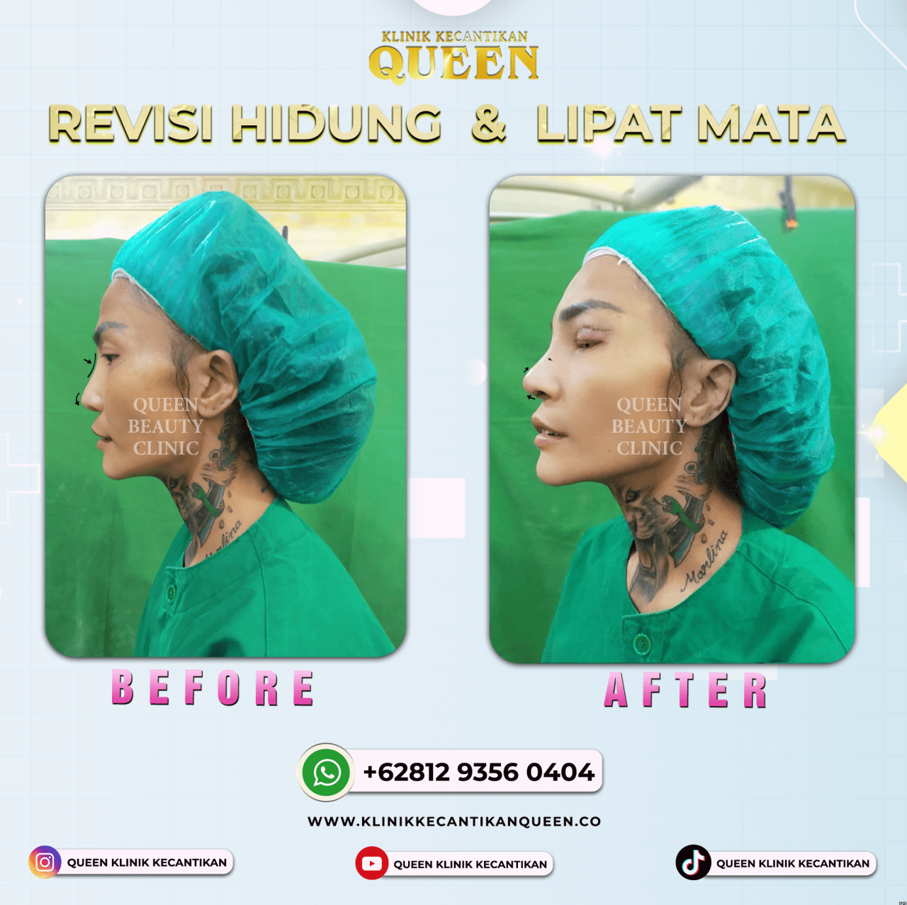 REVISI HIDUNG & LIPAT MATA